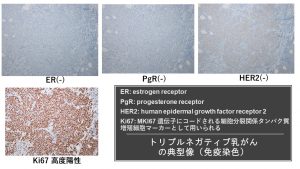 トリプルネガティブ乳がん